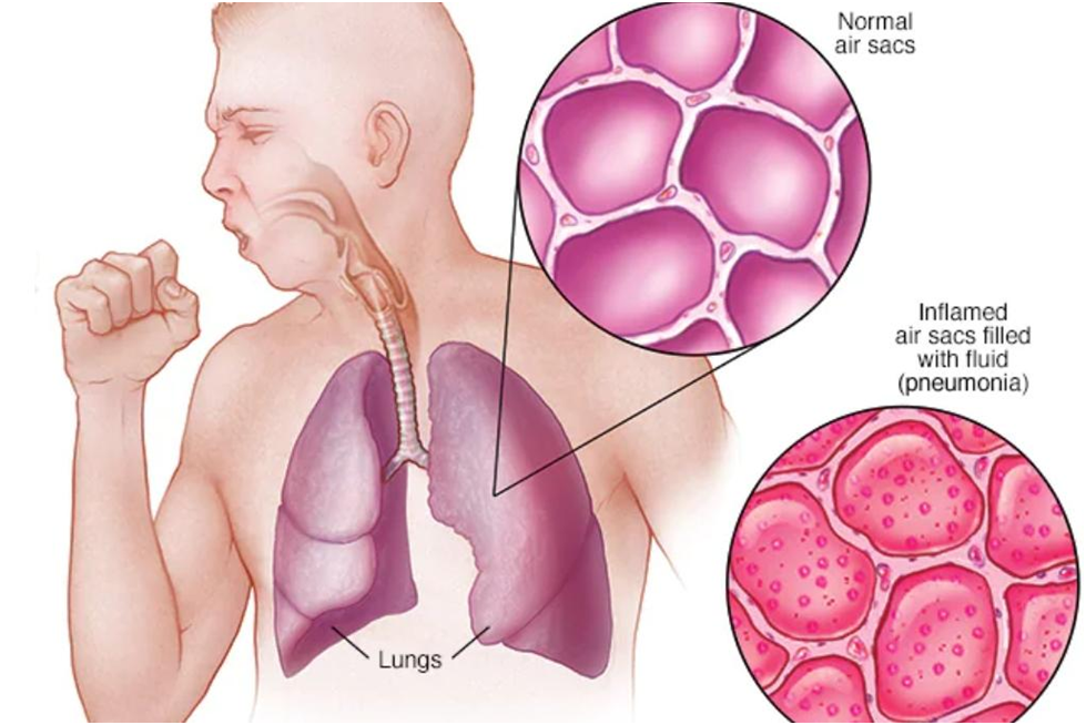 Symptoms of pneumonia