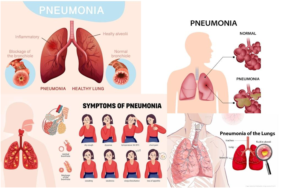 Pneumonia